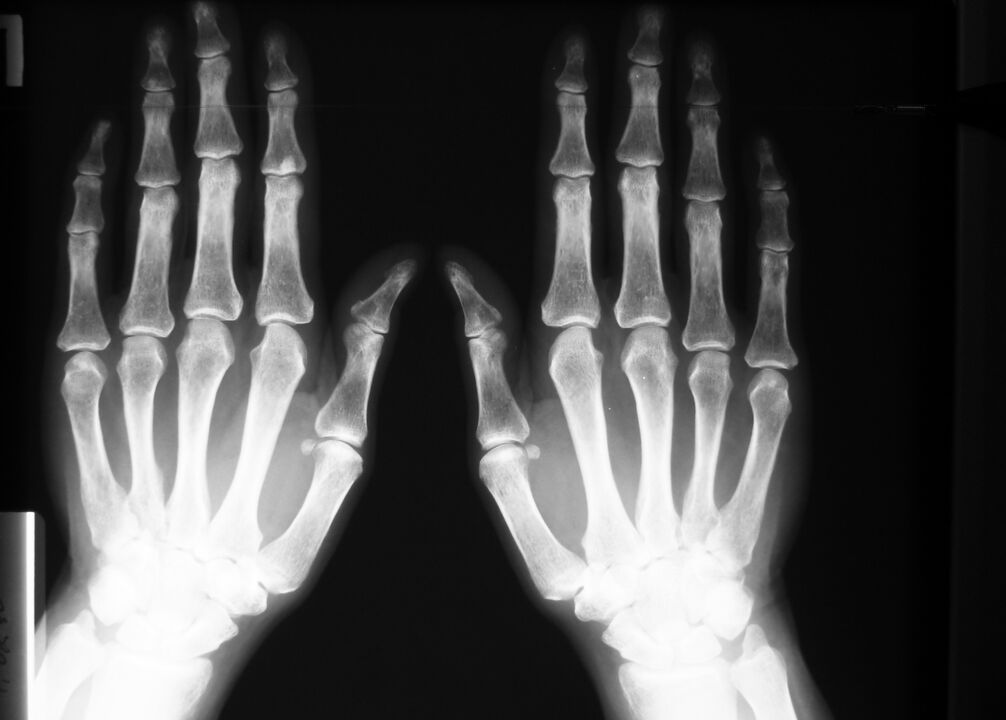 röntgen na diagnostiku bolesti v kĺboch ​​prstov
